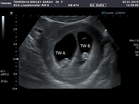 what is a dating ultrasound